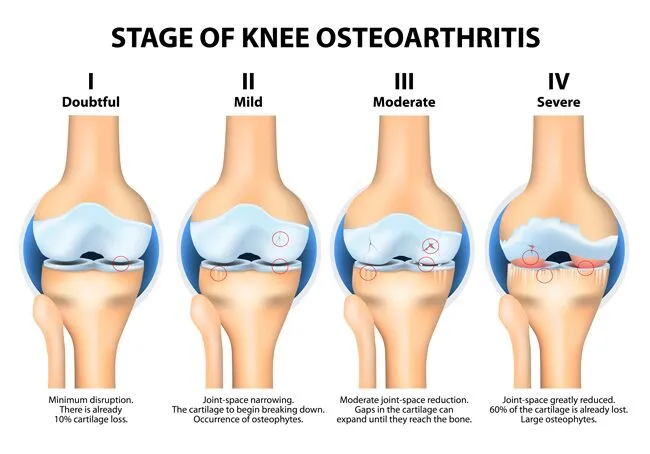 Physiotherapy After Knee Replacement
